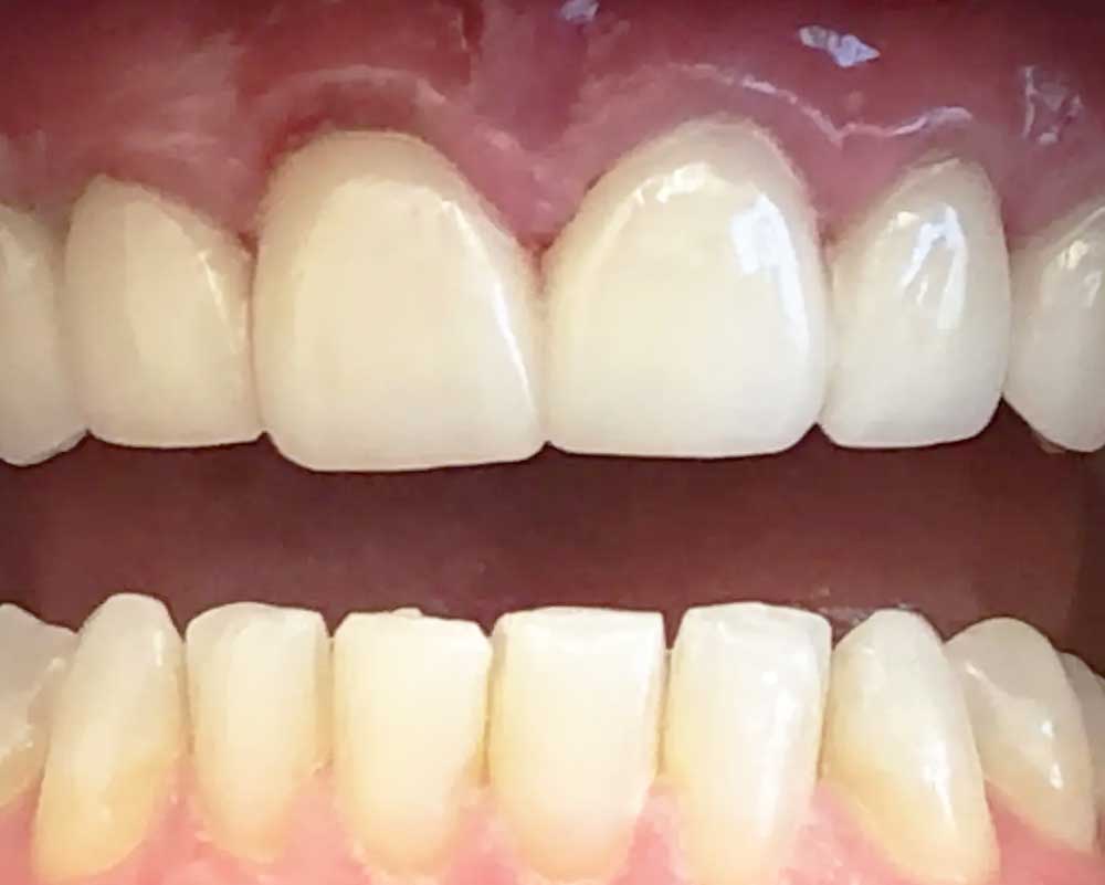 Close-up of clean teeth at Whittier Palm Dental in Montebello, CA