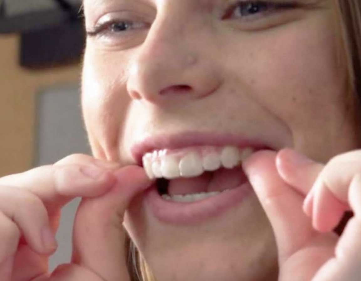 Person fitting clear dental aligners at Whittier Palm Dental in Montebello, CA