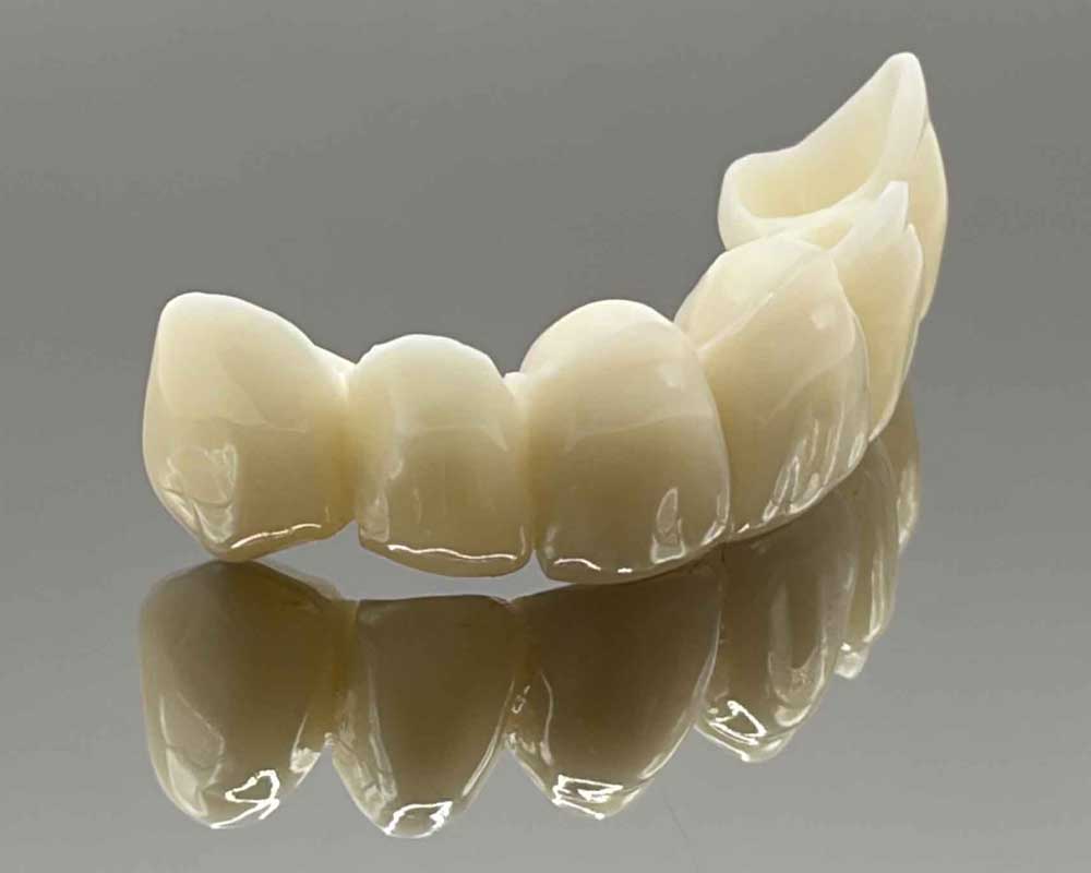 Dental bridge prosthetic close-up by Whittier Palm Dental in Montebello, CA