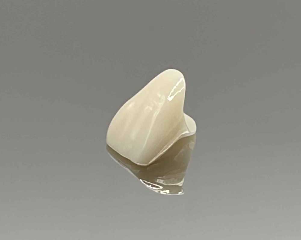 Close-up of dental crown restoration by Whittier Palm Dental in Montebello, CA