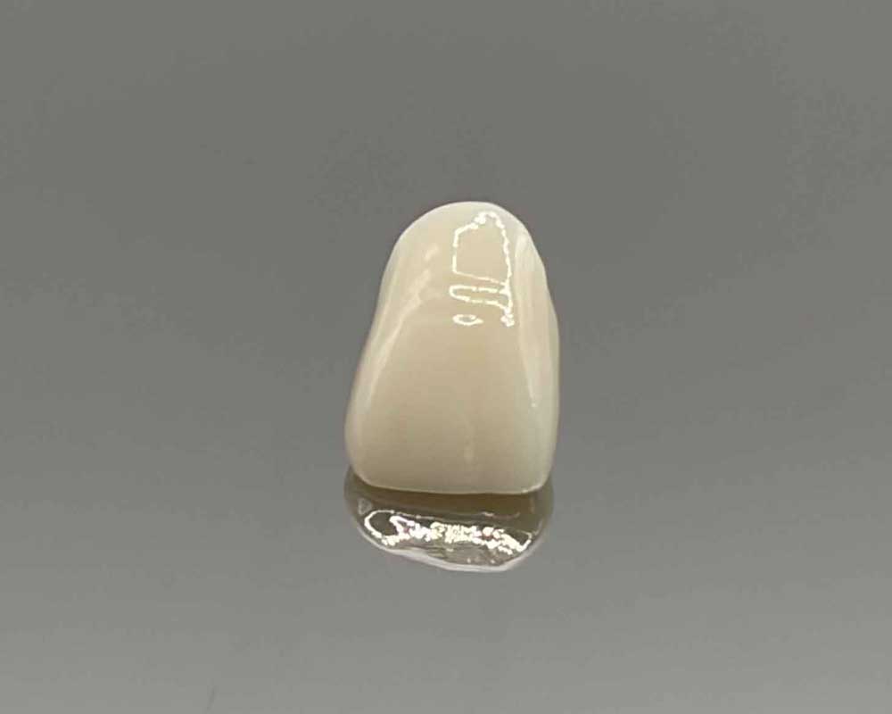 Dental crown restoration by Whittier Palm Dental in Montebello, CA on reflective surface